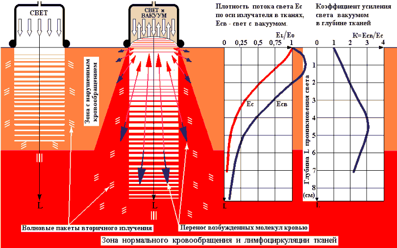 Схема усиления светового воздействия вакуумом в глубине биотканей с помощью аппарата свето-вакуумной импульсной терапии СВИТ